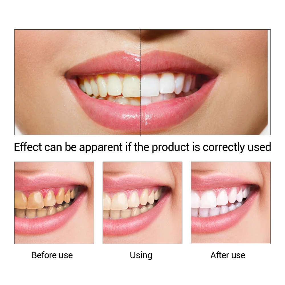 FTEENPLY Teeth Whitening Essen - Teeth Whitening Q&M review and price