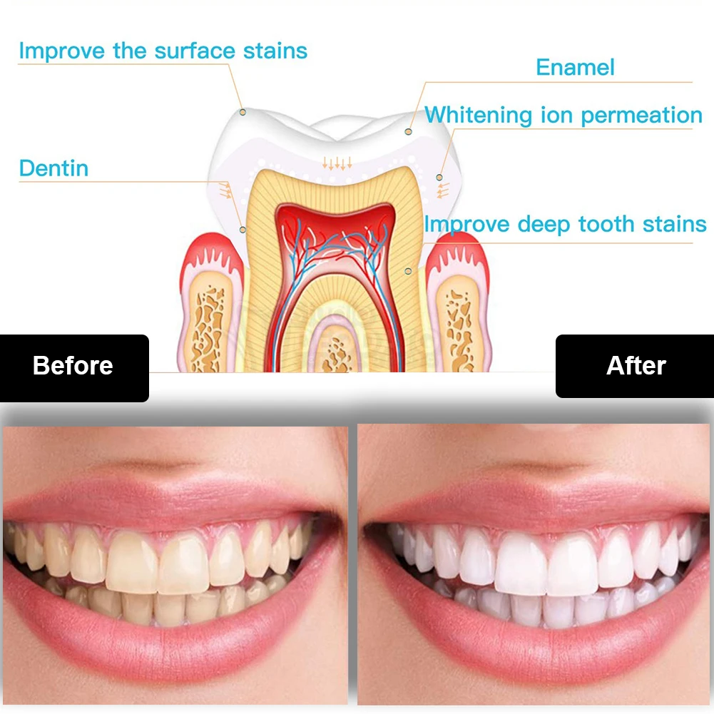 Dental Teeth Whitening Kit Min - Teeth Whitening Q&M review and price