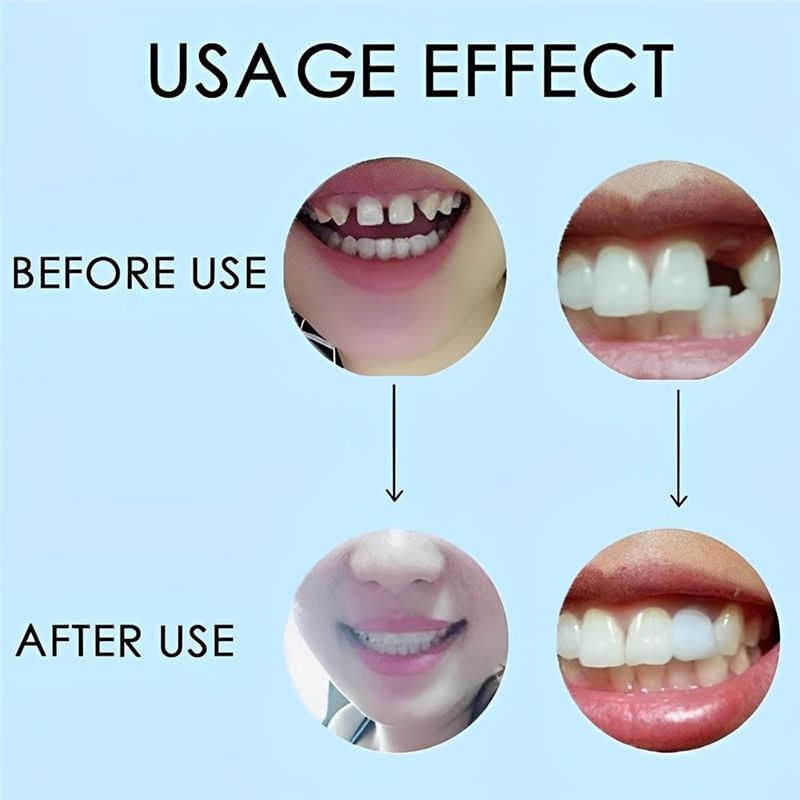 [NEW!ABMK】 2 Pairs,Regain Beau - Teeth Whitening With Braces review and price